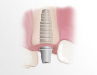 dent-implant